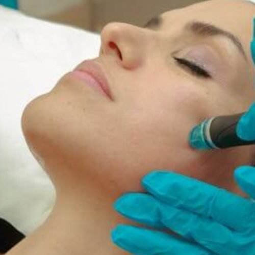 A woman is getting microneedling: How long does microneedling last?