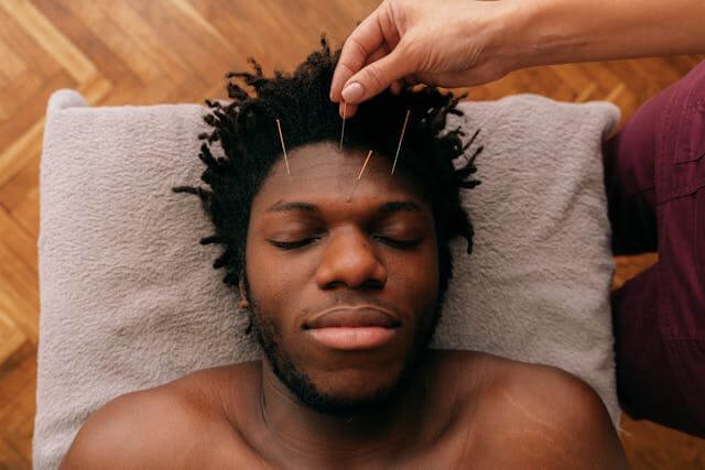 A man lying down is getting a facial acupuncture treatment
